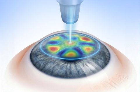 Wavefront Guided LASIK treatment
